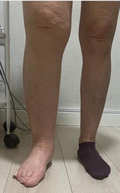 mejora pierna hinchada